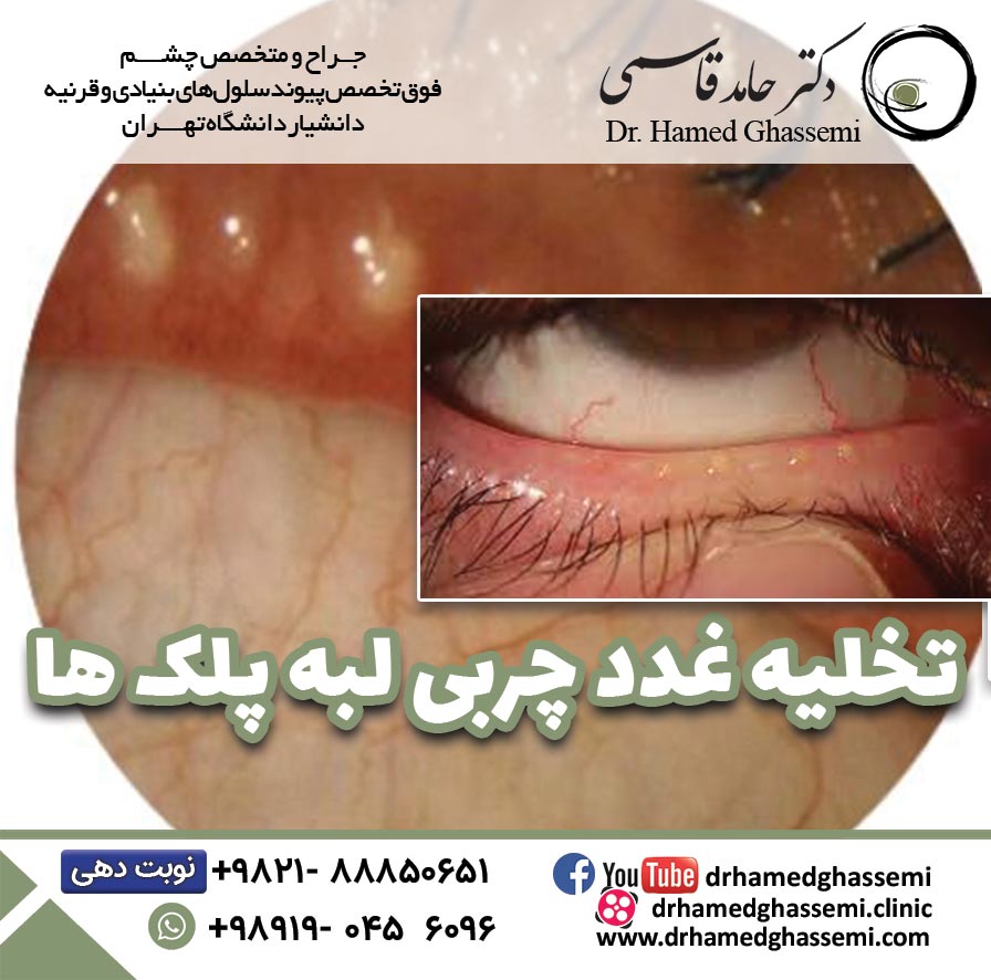 تخلیه غدد چربی لبه پلک‌ها (کلیپ شماره 2)